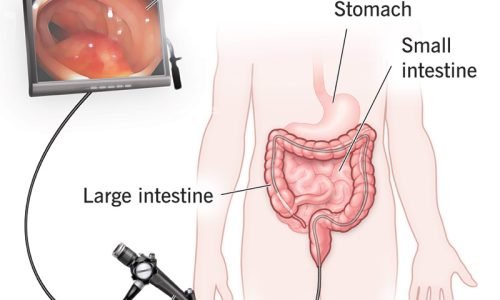 4949-colonoscopy