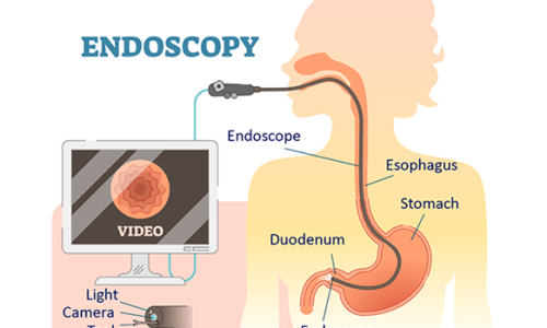 Endoscopy